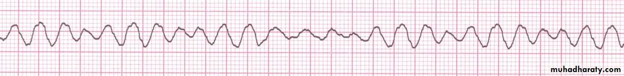Acute coronary syndrome