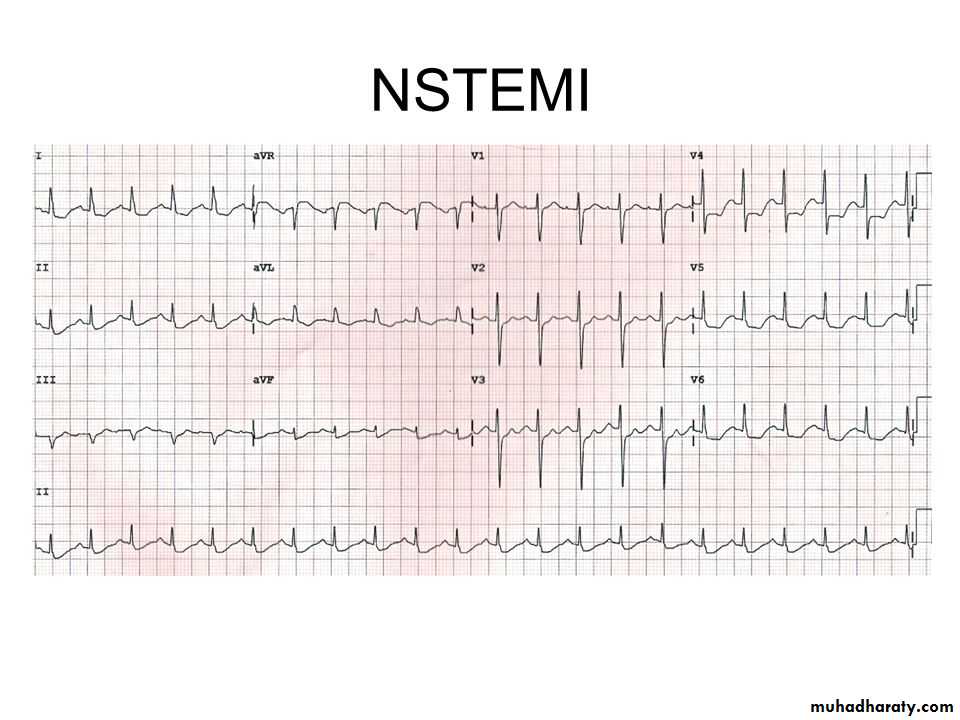 Acute coronary syndrome