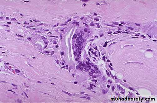 Chronic inflammation