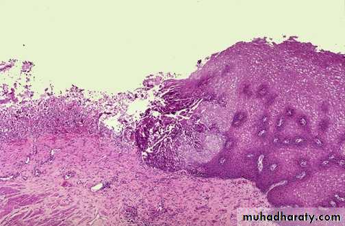 Chronic inflammation