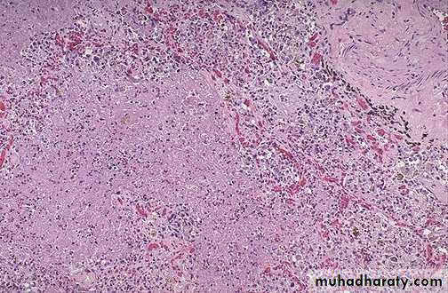 Chronic inflammation