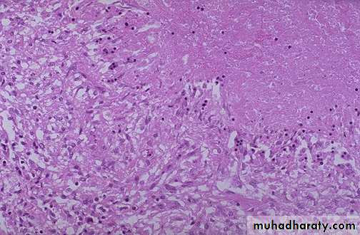 Chronic inflammation