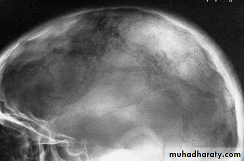 Skull X-Rays