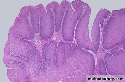 Neoplasia