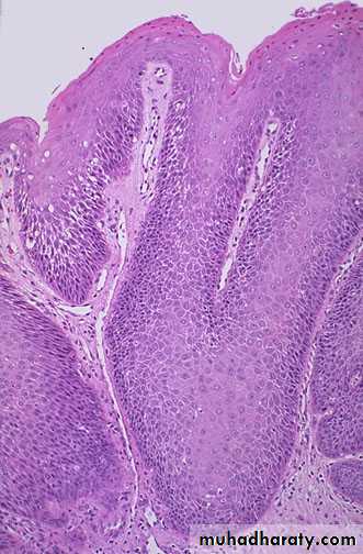 Neoplasia