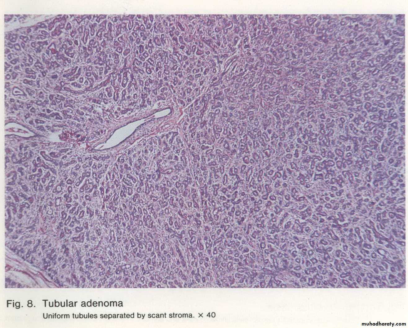 Neoplasia