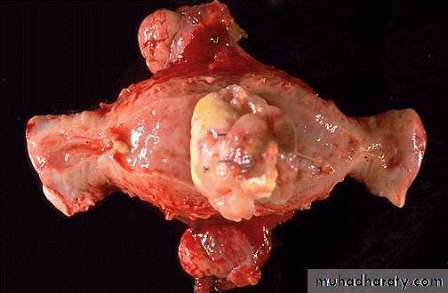Neoplasia