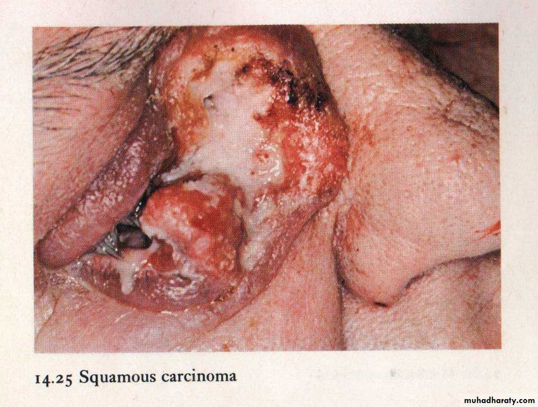 Neoplasia