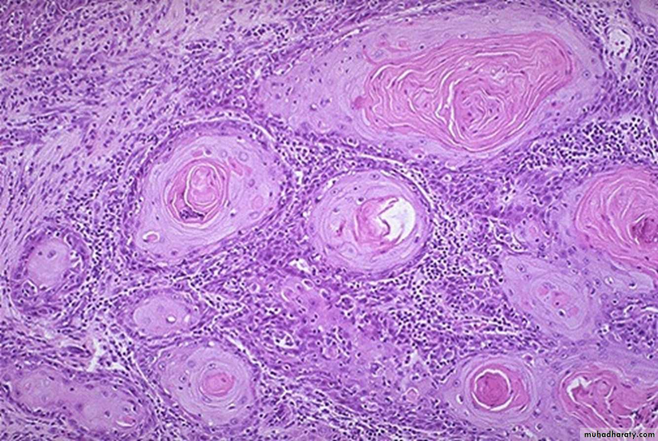Neoplasia