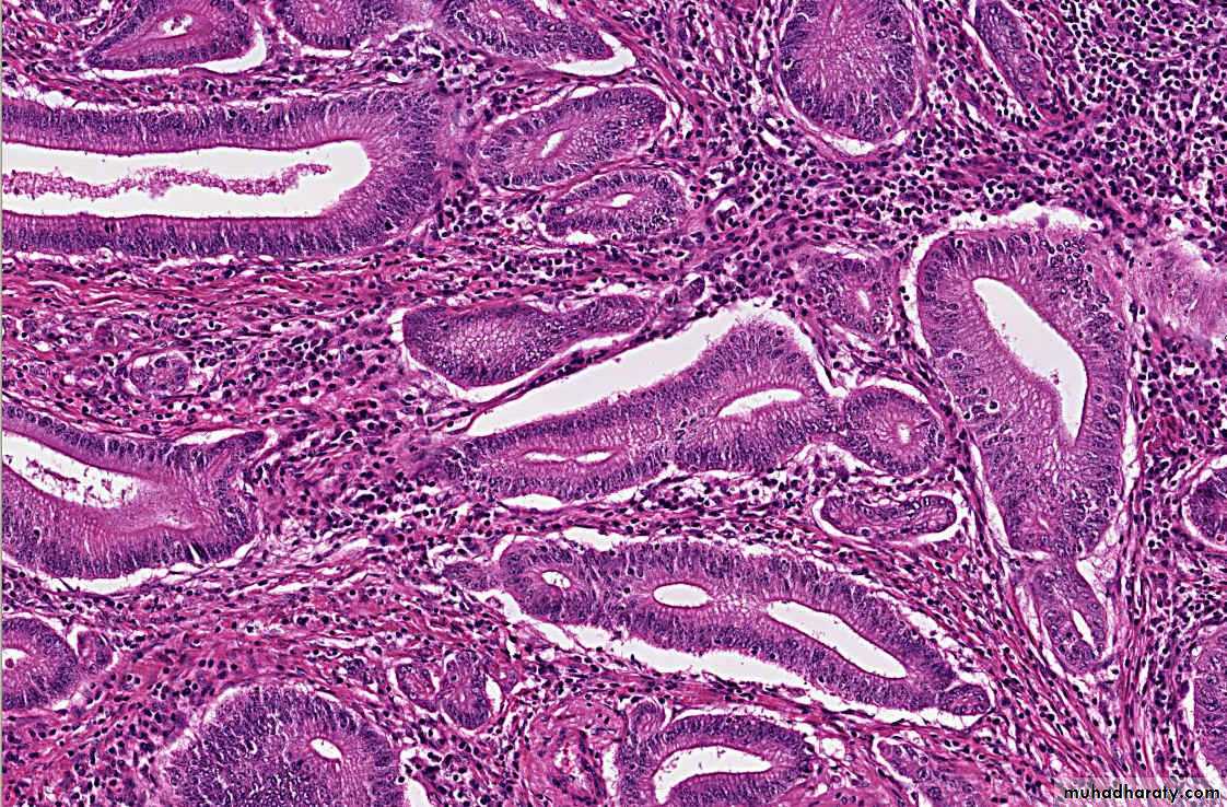 Neoplasia