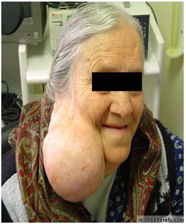 Neoplasia