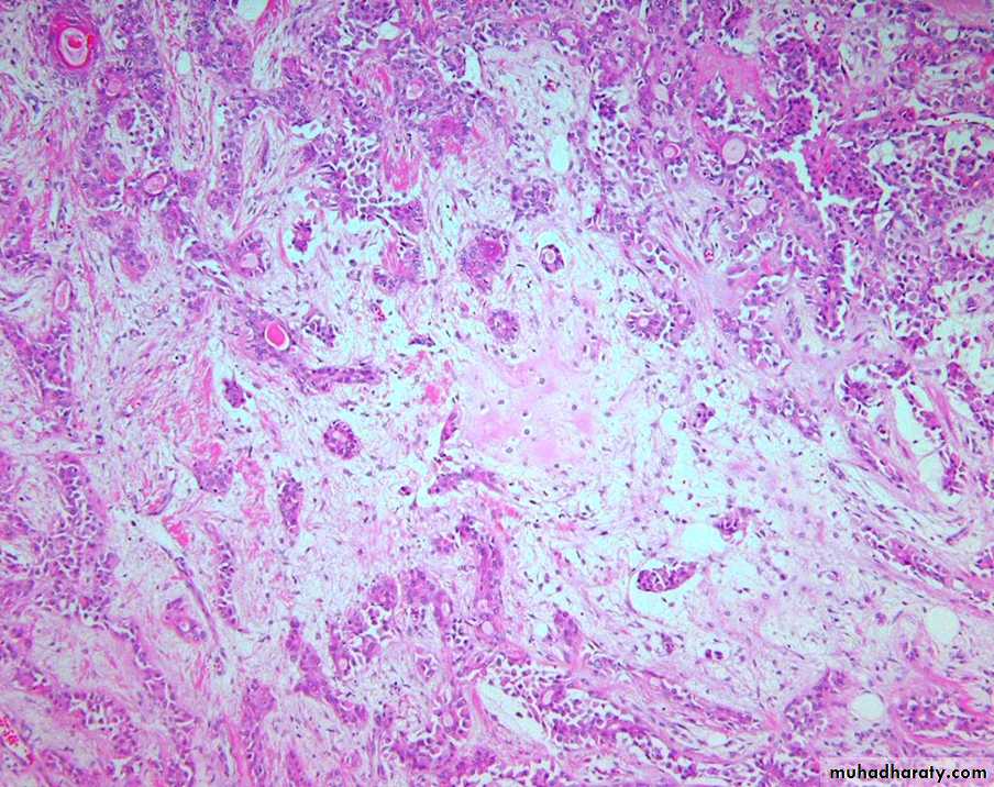Neoplasia