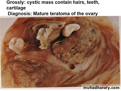 Neoplasia