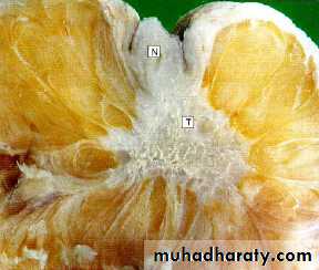 Neoplasia