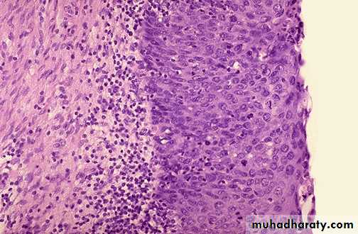 Neoplasia
