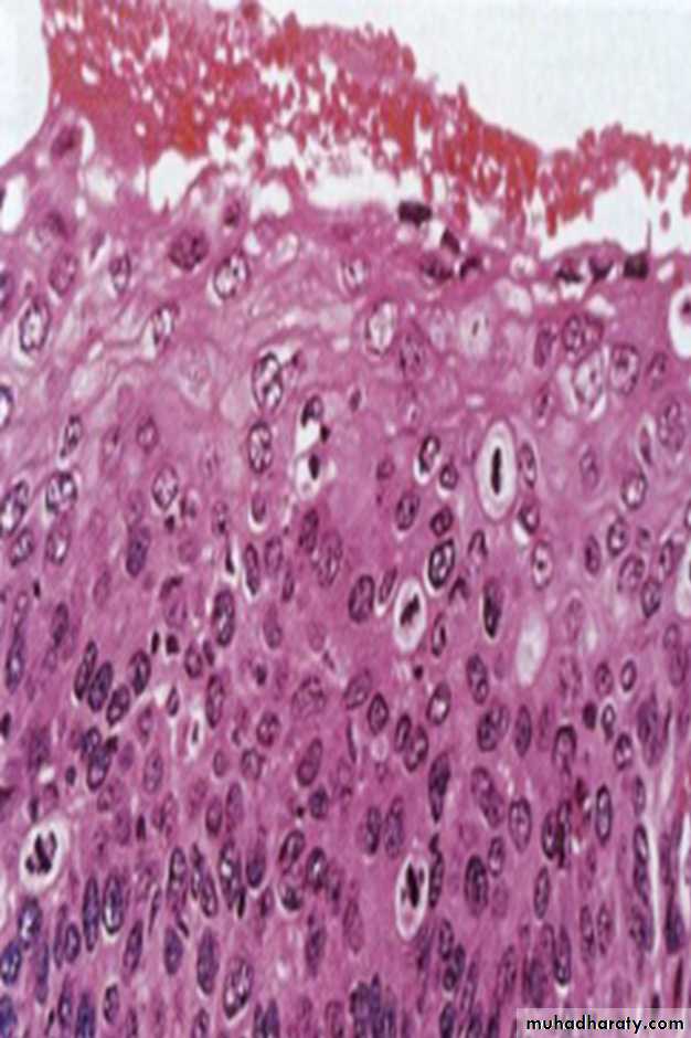 Neoplasia