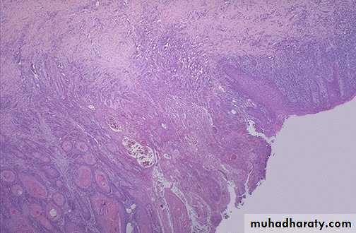 Neoplasia