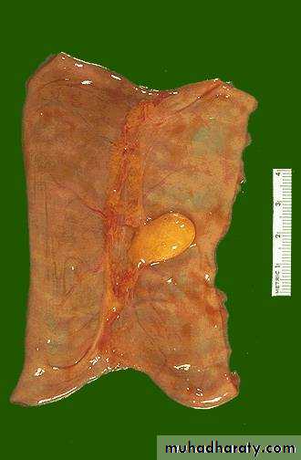 Neoplasia