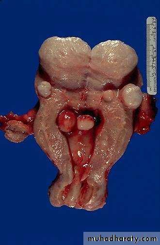 Neoplasia