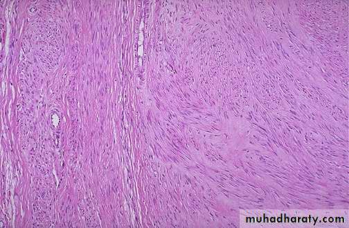 Neoplasia