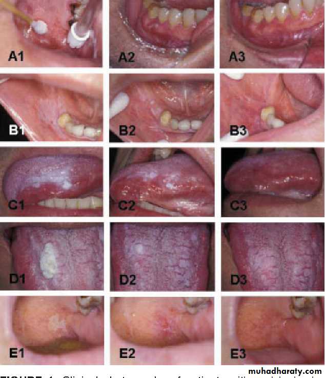 Cryosurgery