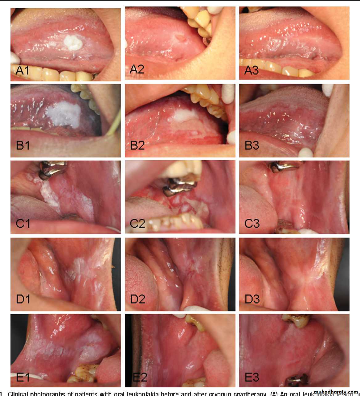 Cryosurgery