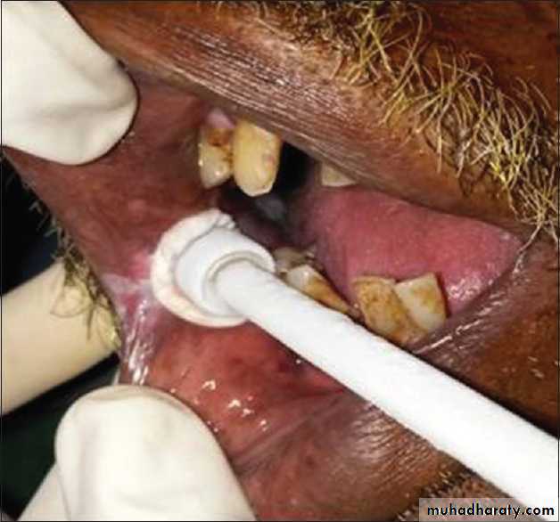 Cryosurgery