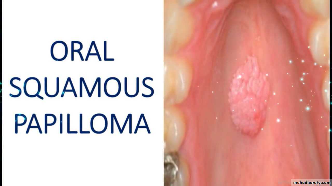 Neoplasia