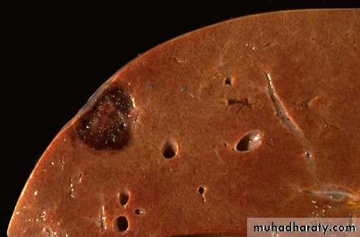 Neoplasia