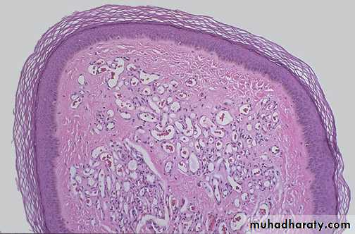 Neoplasia