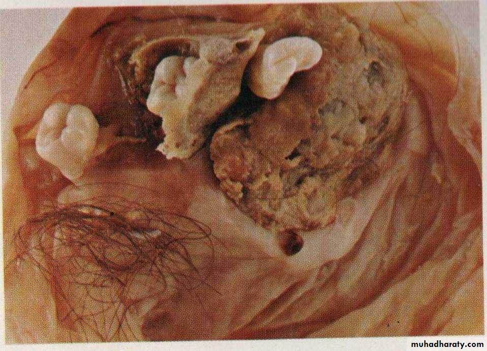 Neoplasia
