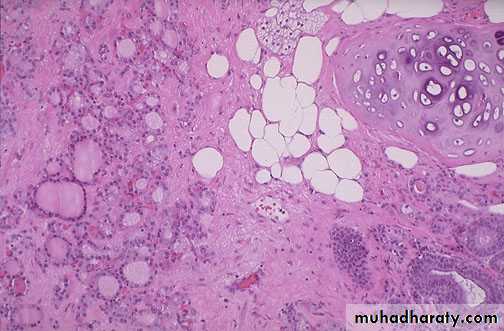 Neoplasia