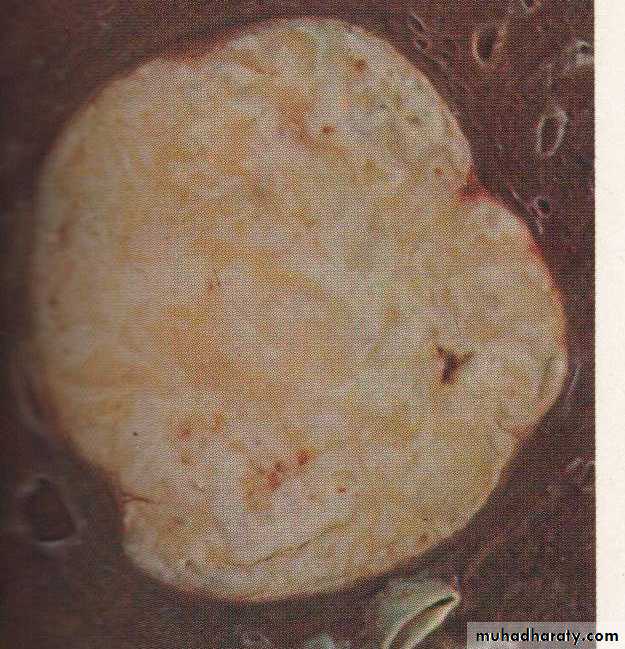 Neoplasia