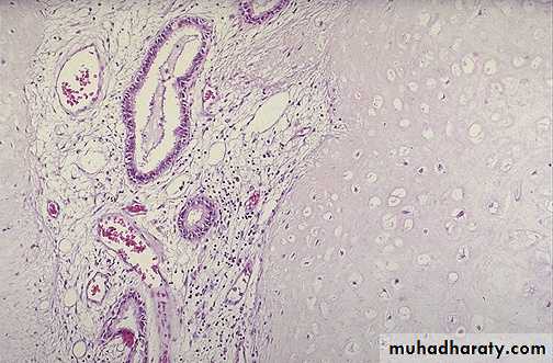 Neoplasia
