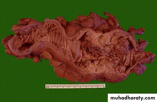 Neoplasia