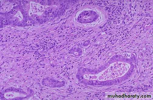 Neoplasia