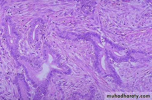 Neoplasia