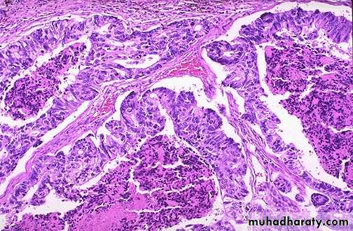 Neoplasia