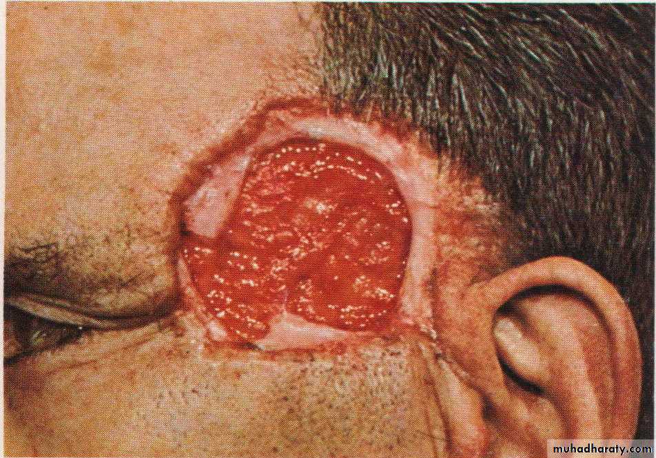 Neoplasia