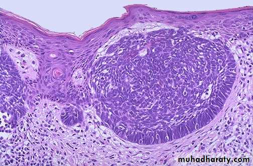 Neoplasia