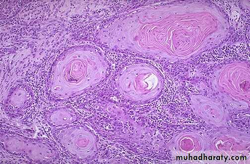 Neoplasia