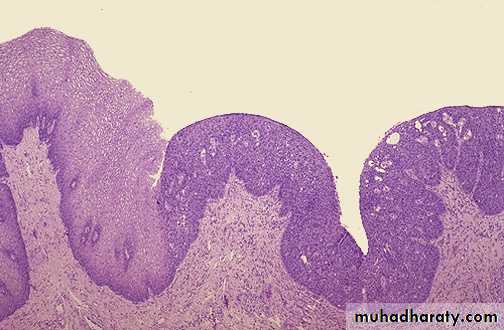Neoplasia