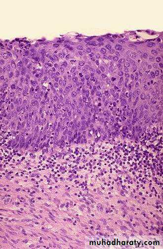 Neoplasia