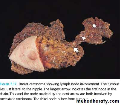 Neoplasia