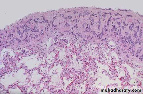 Neoplasia