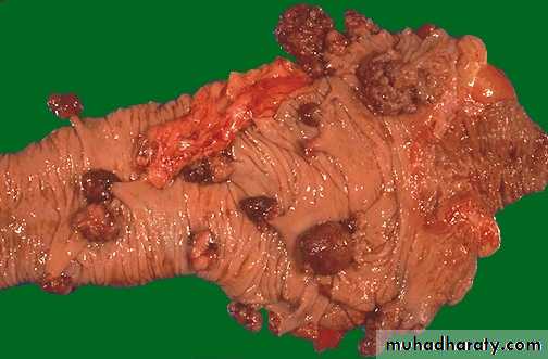 Neoplasia