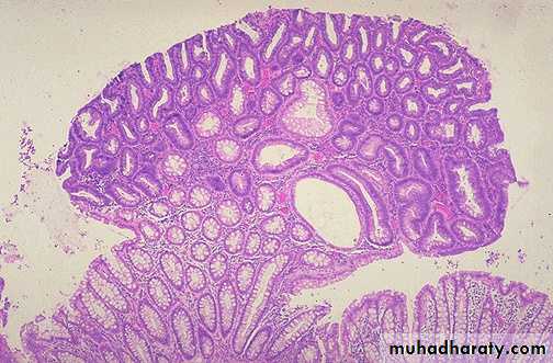 Neoplasia