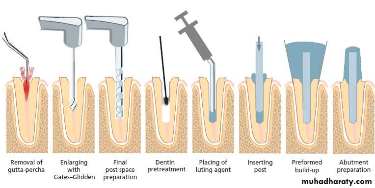 Post and core