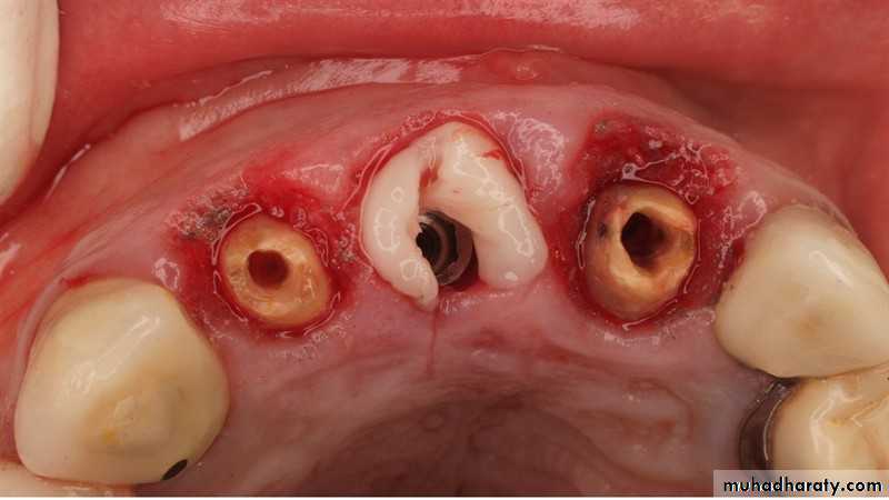 Post and core