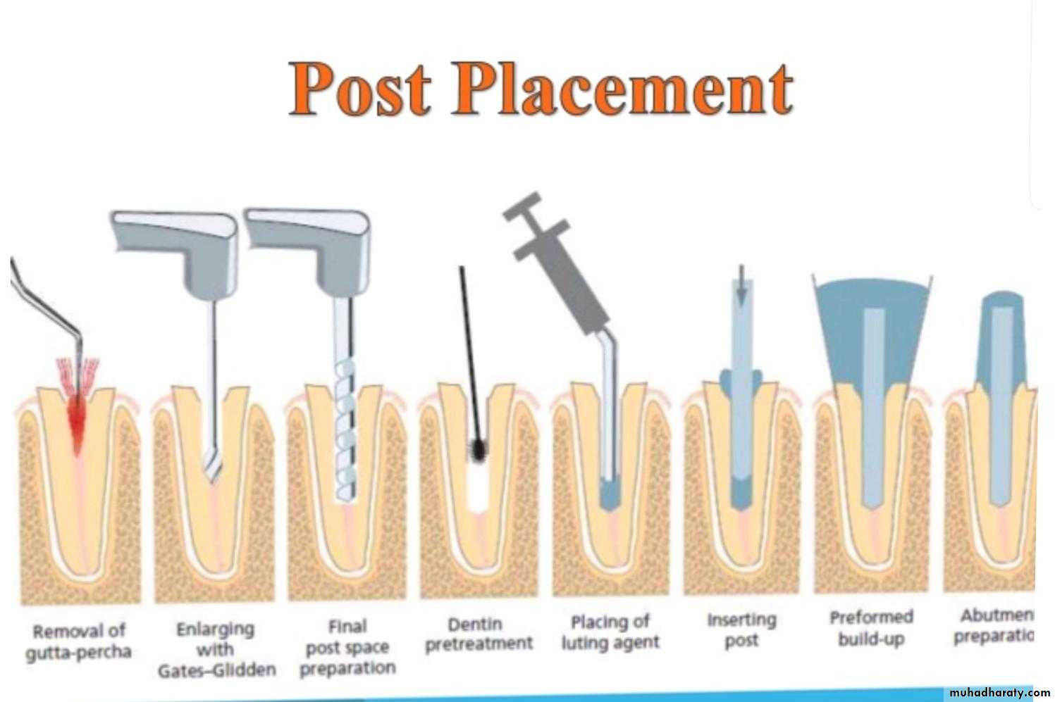 Post and core
